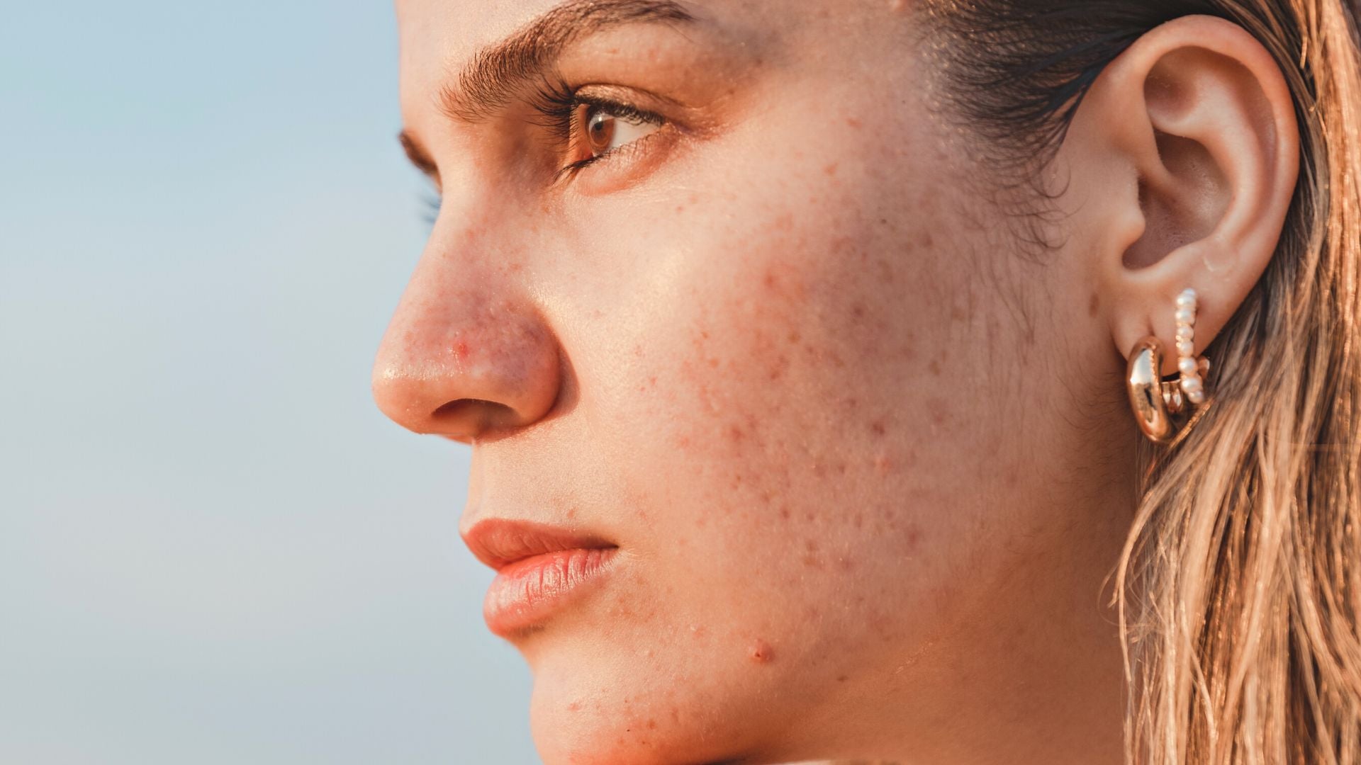 Separating Fact From Fiction: Does Sunscreen Cause Acne?