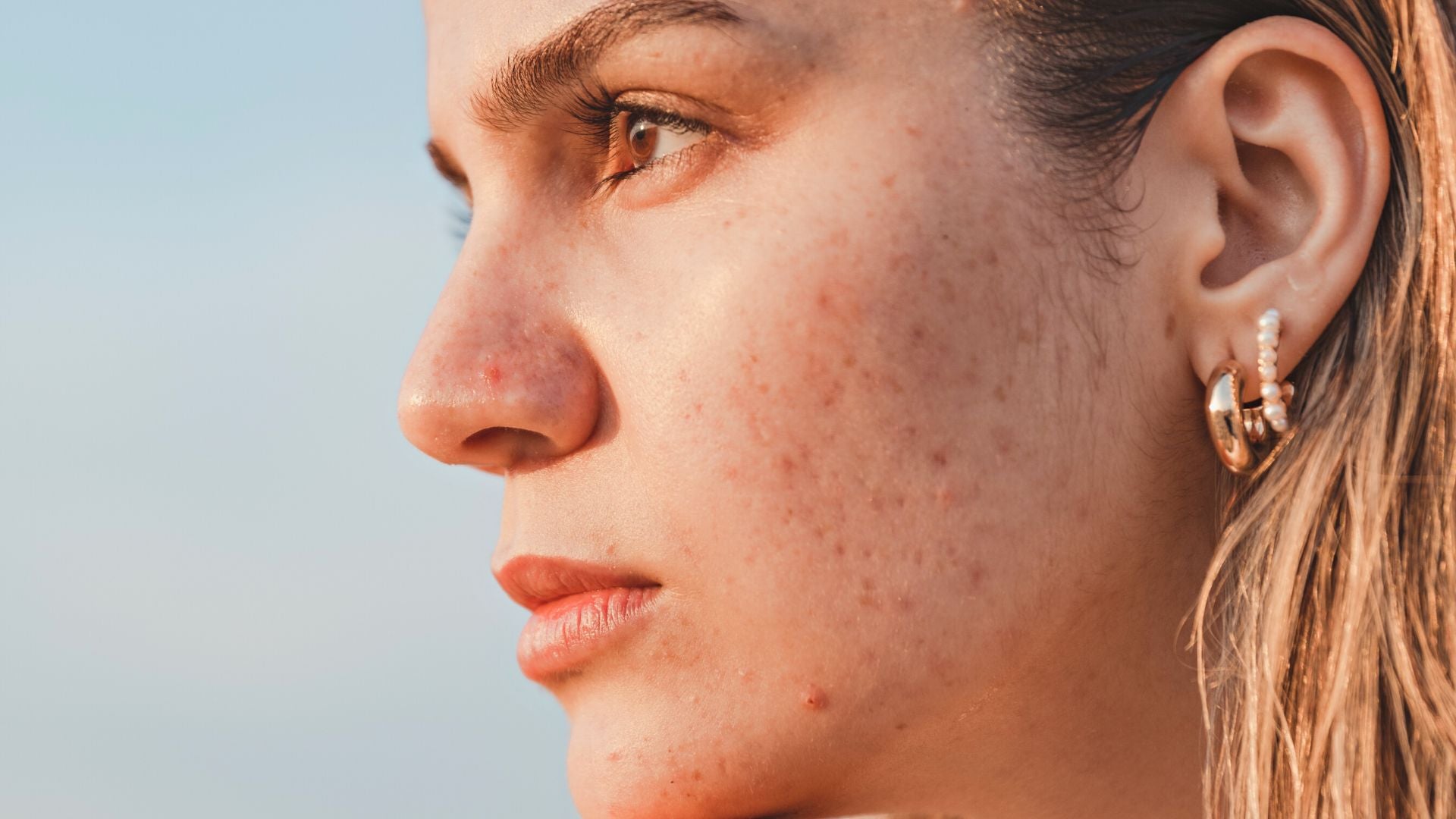 Separating Fact From Fiction Does Sunscreen Cause Acne? People4Ocean
