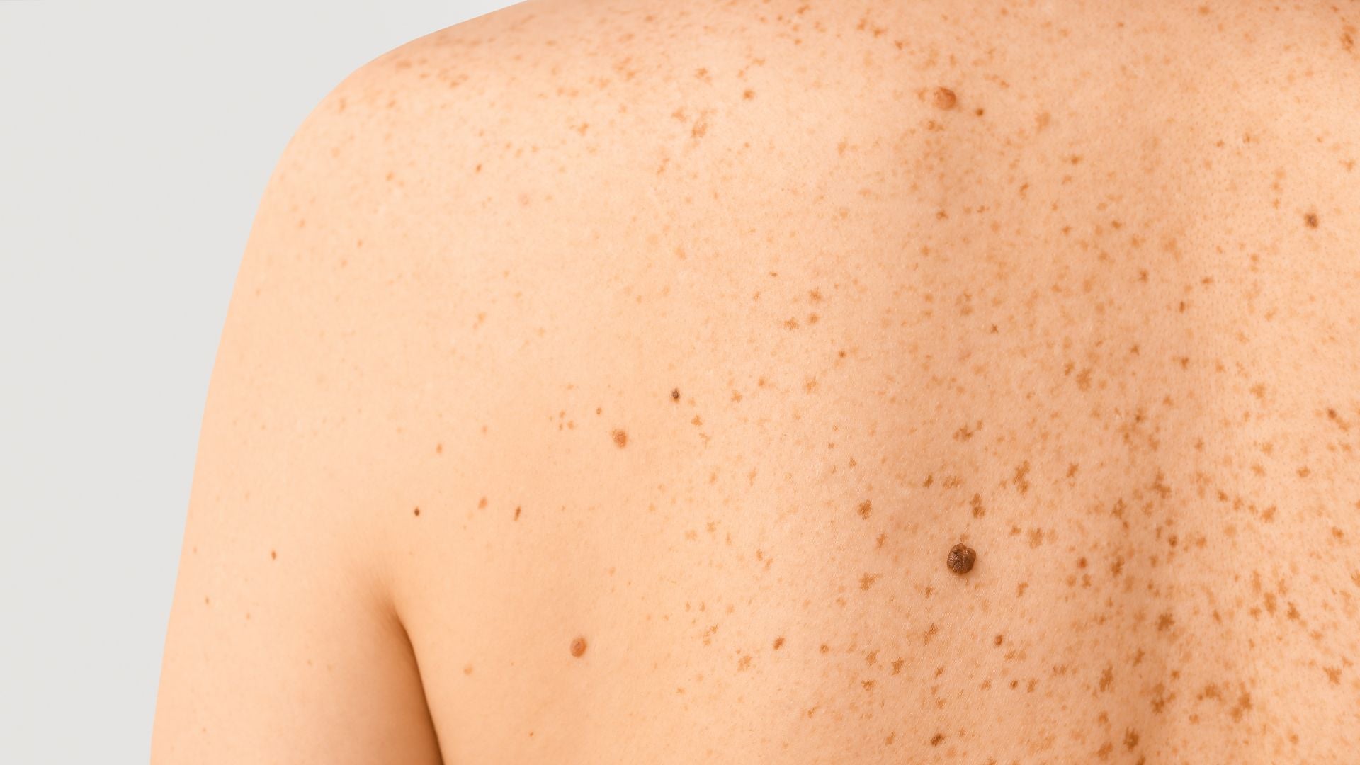 A person's back covered in moles